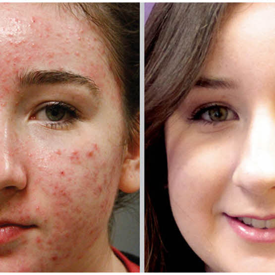 Acne Treatments Acne Treatments