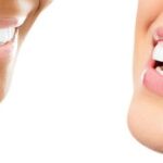 LASER TEETH WHITENING ONLY $95